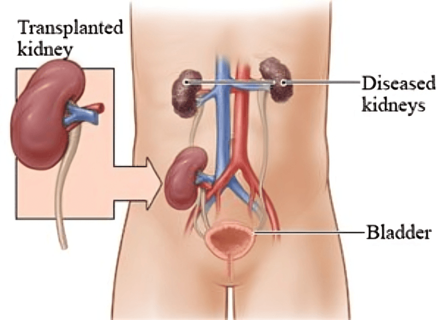 KidneyImg